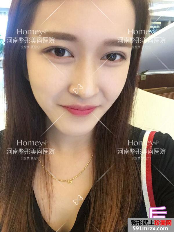 郑州,整形,切开法,平扇,双眼皮,恢复,过程,美图,来袭