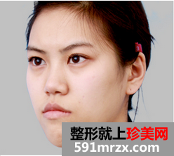 广空后勤,整形,医院,双鄂,颧骨,整形,假小子,逆袭,成为,萌妹子