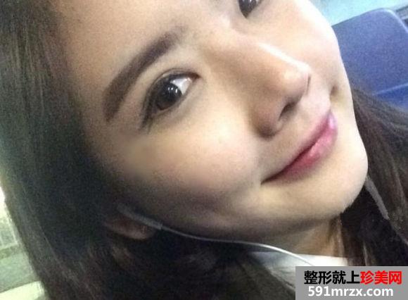 北京伊美尔健翔医院,北京驼峰鼻矫正多少钱