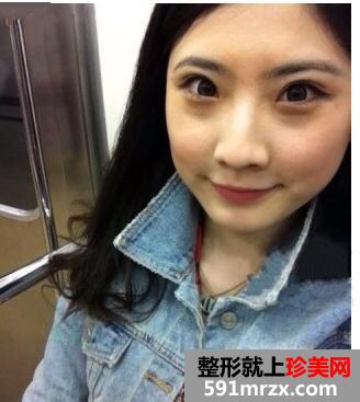 北京伊美尔健翔医院,北京驼峰鼻矫正多少钱