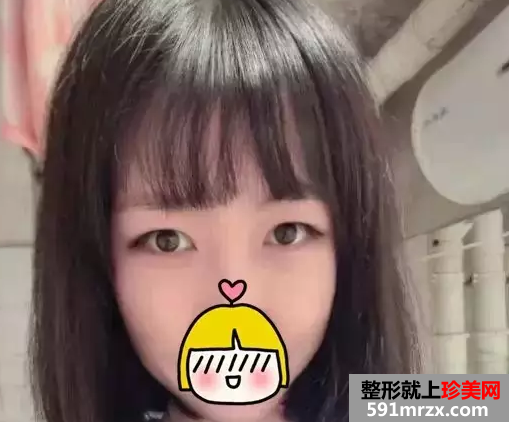 双眼皮,失败,修复,手术,过程,真实,效果图