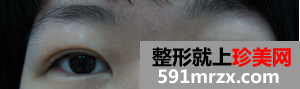 双眼皮,失败,修复,手术,过程,真实,效果图