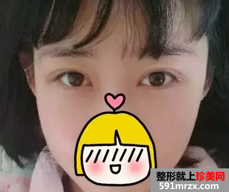 双眼皮,失败,修复,手术,过程,真实,效果图