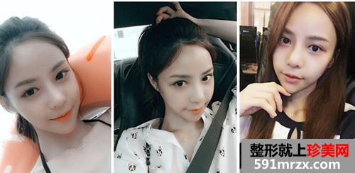 下颌角整形+膨体隆鼻前后效果对比图真实案例和恢复过程