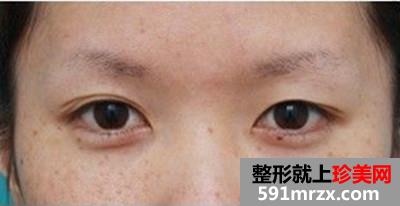 台州,整形,医院,埋线,双眼皮,一单一双