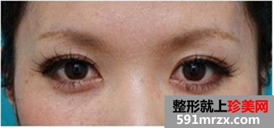 台州整形医院埋线双眼皮手术 告别“一单一双”