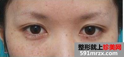 台州整形医院埋线双眼皮手术 告别“一单一双”