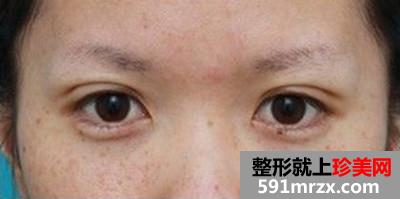 台州整形医院埋线双眼皮手术 告别“一单一双”