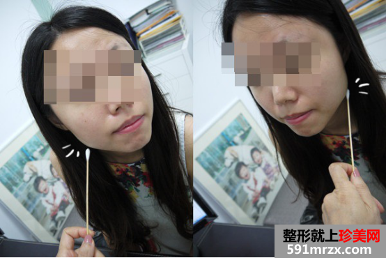 瘦脸前后对比图