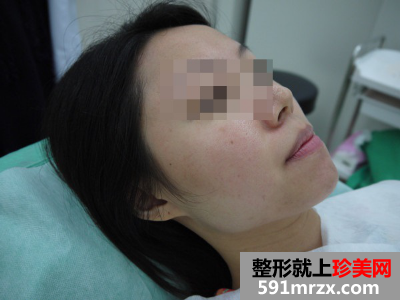 瘦脸前后对比图