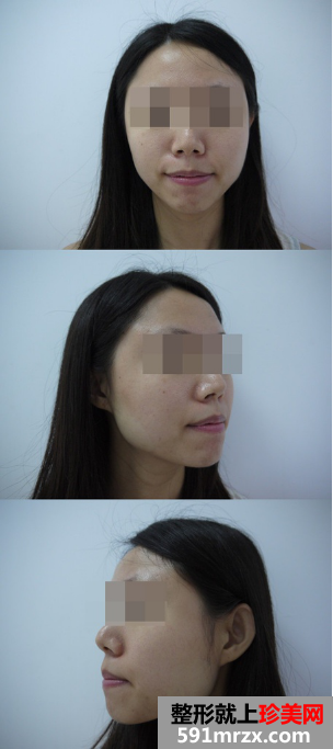 瘦脸前后对比图