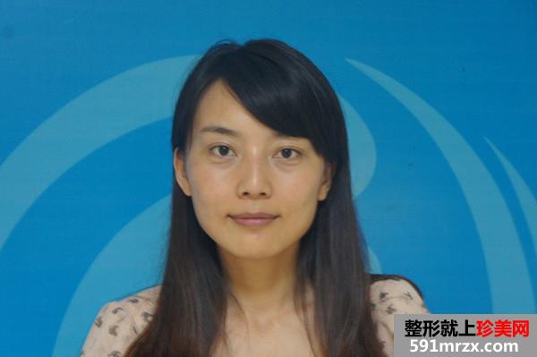 打瘦脸针+溶脂去眼袋手术过程和前后对比图真实案例