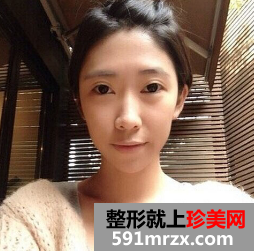 北京凯润婷综合隆鼻+面部脂肪填充手术经历