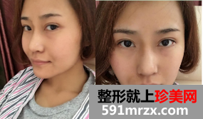 上海时光鼻尖软骨移植隆鼻整形越变越完美喽