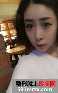 注射,玻尿酸,隆鼻,下颌角,磨骨,手术,过程,恢复,前后,对比照