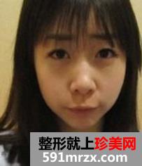 注射,玻尿酸,隆鼻,下颌角,磨骨,手术,过程,恢复,前后,对比照