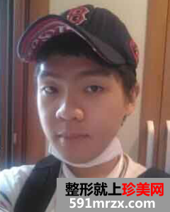 男生面部整形前后效果对比