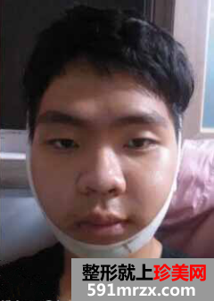 男生面部整形前后效果对比
