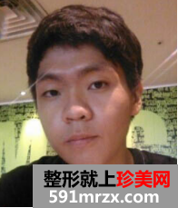 男生面部整形前后效果对比