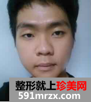 男生面部整形前后效果对比