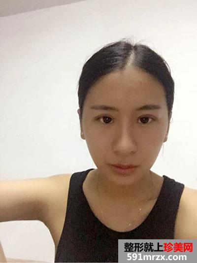 双眼皮＋隆下巴手术案例分享