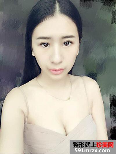双眼皮＋隆下巴手术案例分享