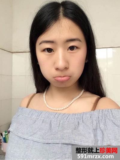 双眼皮＋隆下巴手术案例分享