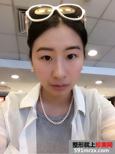 双眼皮＋隆下巴手术案例分享