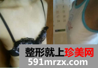 北京八大处假体隆胸恢复过程分享