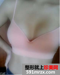 北京八大处假体隆胸恢复过程分享