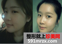 割双眼皮+硅胶隆鼻整形+面部综合整形恢复日记