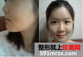 割双眼皮+硅胶隆鼻整形+面部综合整形恢复日记