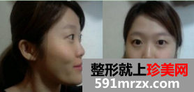 割双眼皮+硅胶隆鼻整形+面部综合整形恢复日记