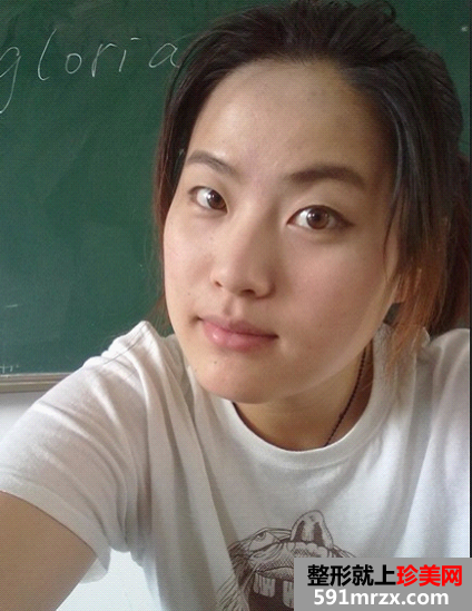 【真人案例】做双眼皮一年了，给大家做个参考