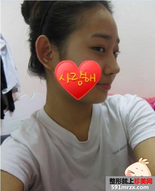 【真人案例】隆鼻5个月了，再画个妆吓倒你们