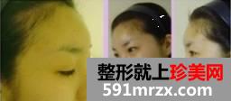 【真人案例】自体脂肪丰全脸，我都偷笑了，你觉得这是成功了吗