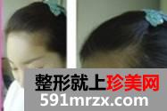 【真人案例】自体脂肪丰全脸，我都偷笑了，你觉得这是成功了吗