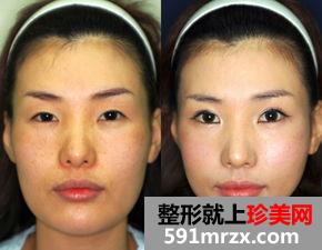 【真人案例】一鼓作气去打了瘦脸针，来看看效果如何吧