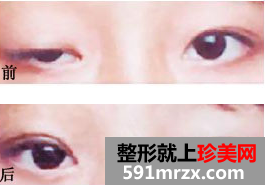 上睑下垂矫正手术前后对比.png