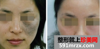 去面部,色素痣,手术,前后,对比,效果,图片