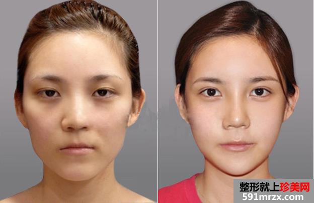 双眼皮,修复,手术,前后,对比,效果,图片