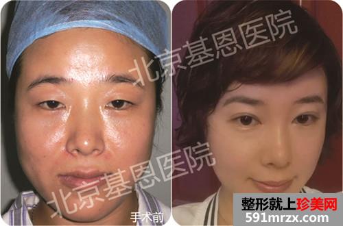 眼部,综合,整形,自体,脂肪,填充,前后,对比,效果,图片