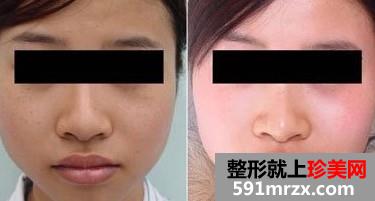 复合,彩光,嫩肤,前后,对比,效果,图片