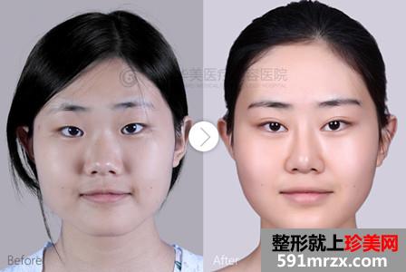 上海,华美,双眼皮,开眼角,隆鼻,下颌角,前后,对比,效果,图片