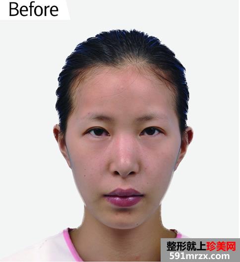韩式双眼皮前后对比效果图片及手术恢复过程