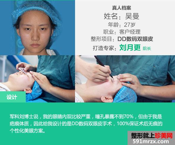 深圳,军科,DD数码双眼皮,前后,对比,效果,图片