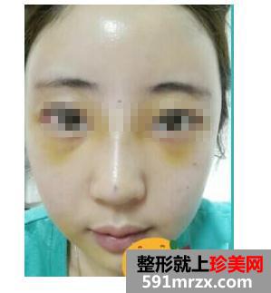 膨体,假体,隆鼻,前后,对比,效果,图片,恢复,过程