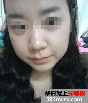 吸脂,减肥,手术,前后,对比,效果,图片