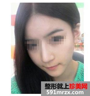 膨体,假体,隆鼻,前后,对比,效果,图片,恢复,过程