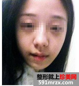 膨体,假体,隆鼻,前后,对比,效果,图片,恢复,过程